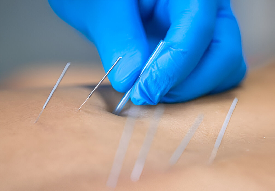Dry Needling